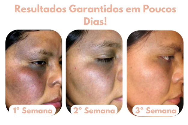 Sérum Facil para Manchas Escuras - Melanin |COMPRE 2 LEVE 3| + Frete grátis