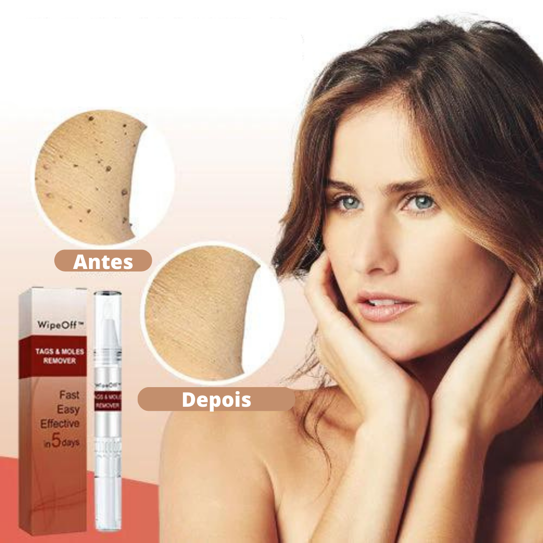 WipeOff™ Removedor de Verrugas |COMPRE 2 LEVE 3| + Frete Grátis