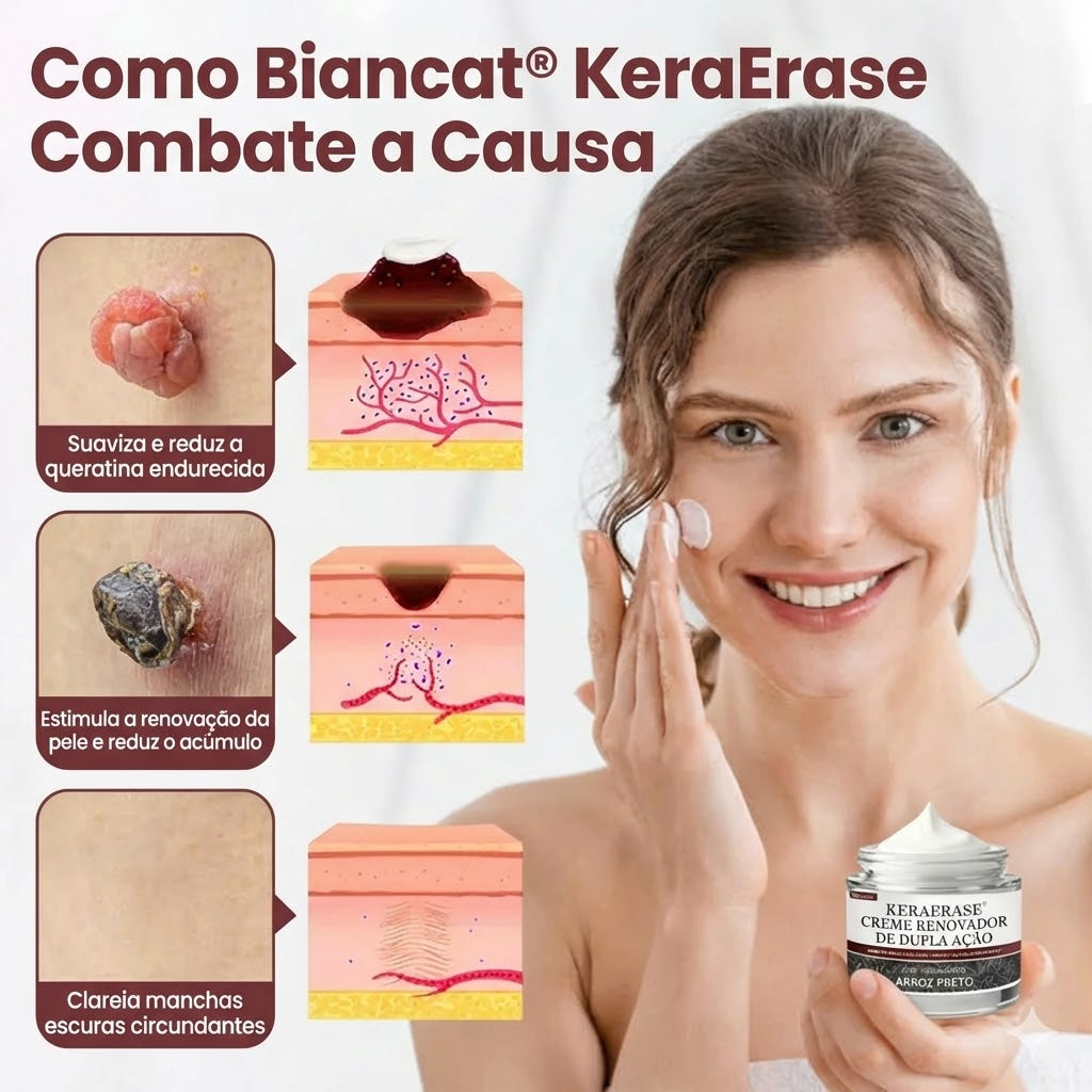 Adeus Verrugas: Creme VERRUE [COMPRE 1 LEVE 2] + Frete Grátis