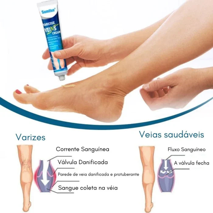 Varicose Veins, Diga adeus para suas Varizes e Inchaços |COMPRE 1 LEVE 2| + Frete Grátis